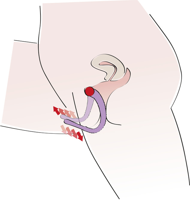 divaricatori di labbra-applicazione-disegno-lato-dipendenza
